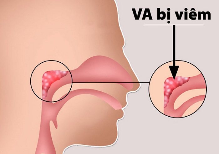 Chỉ định nạo V.A  do viêm nhiễm